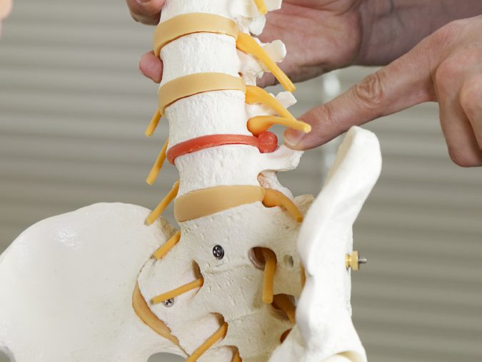 Educational model showing a posterolateral L4/L5 disc herniation affecting a spinal nerve root. Doctor hands pointing to lesion. . 