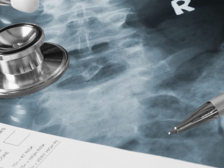 Photo of generic xray, stethoscope and pen with a report in forground. Xray is of lumbosacral spot or lumbar spine AP. 